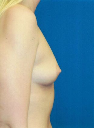 Breast Augmentation : Case 70 (20999) - After