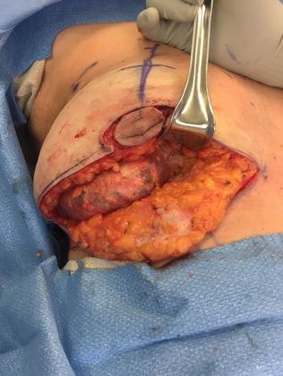 Breast Ruptured Gel Implants: Case 3 (07185) - Before, implant within capsule in place