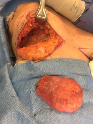 Breast Ruptured Gel Implants: Case 3 (07185) - After capsulectomy, complete