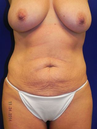 Body Mommy Make-Over: Case 5 (18772) - Before