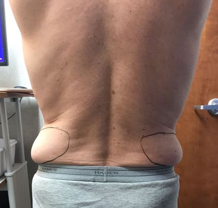 Male Body Contouring Case 4 (22907)