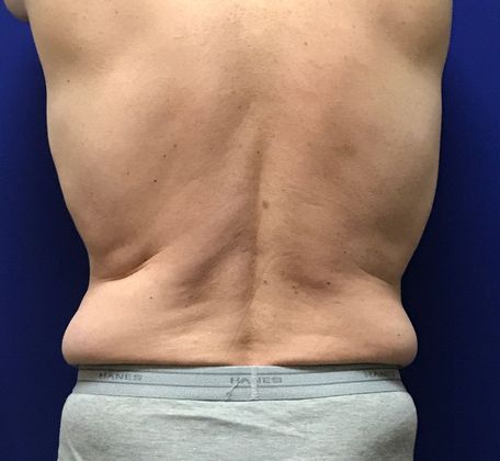 Male Body Contouring: Case 4 (22907) - Before