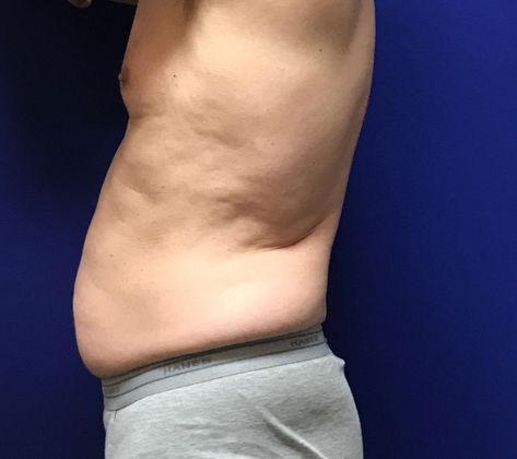 Male Body Contouring: Case 4 (22907) - Before