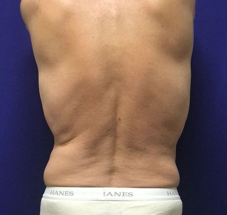 Male Body Contouring: Case 4 (22907) - After