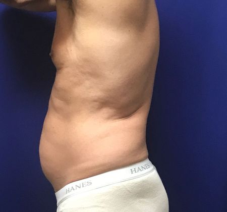 Male Body Contouring: Case 4 (22907) - After