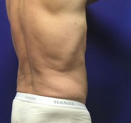 Male Body Contouring: Case 4 (22907) - After