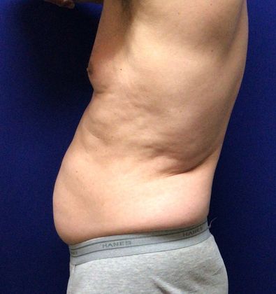 Body Coolsculpting: Case 4 (22907) - Before.  Bulge above waistband.