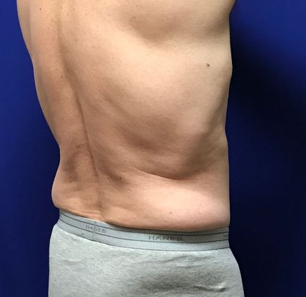 Body Coolsculpting: Case 4 (22907) - Before