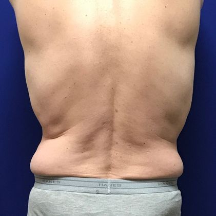 Body Coolsculpting: Case 4 (22907) - Before