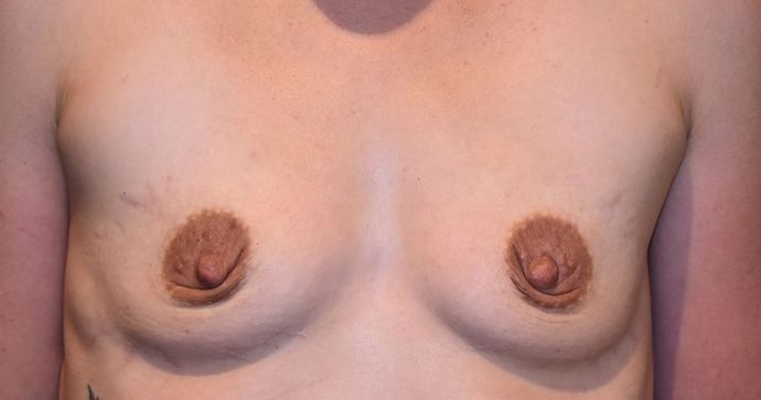 Breast Augmentation Case 555 - Before