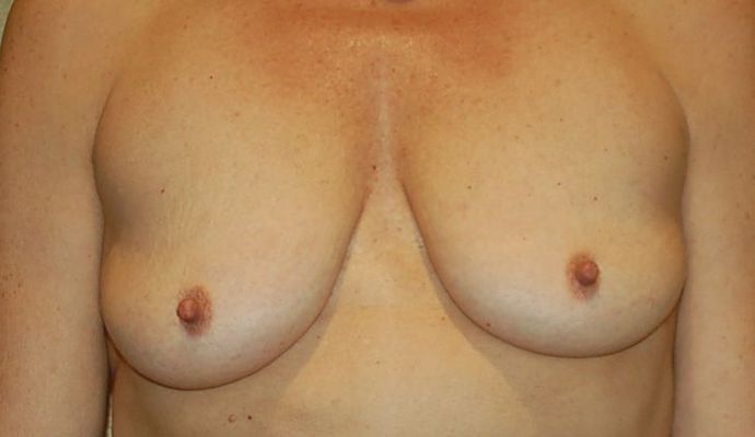 Breast Augmentation w/ Lift: Case 268 - Before