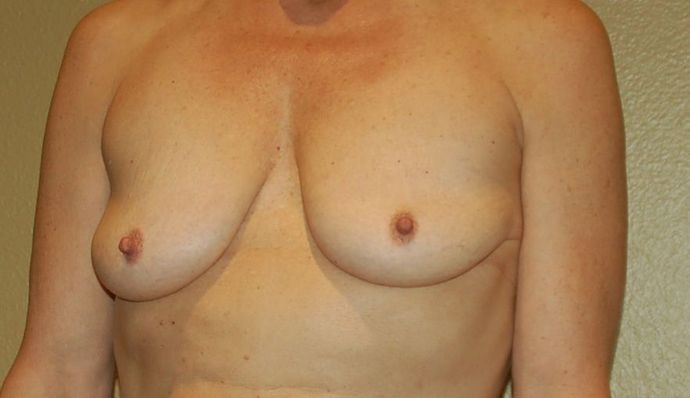 Breast Augmentation w/ Lift: Case 268 - Before