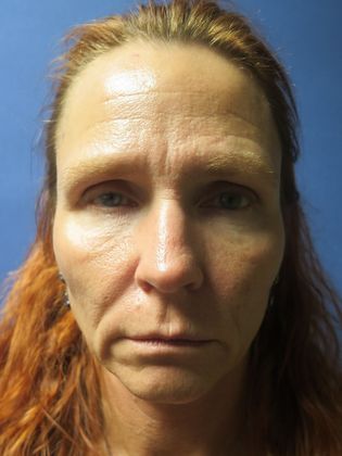 Facelift / RestoreLift Case 4 - Before