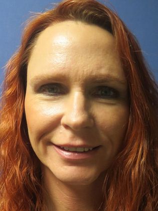 Facelift / RestoreLift Case 4 - After