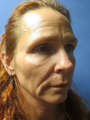 Facelift / RestoreLift: Case 4 - Before