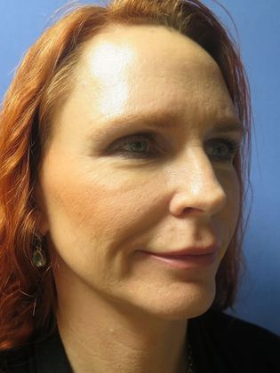 Facelift / RestoreLift: Case 4 - After