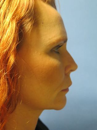 Facelift / RestoreLift: Case 4 - After