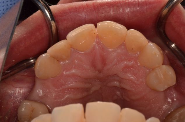 Dental Implants Case 27 - Before