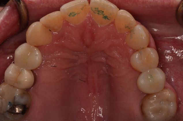 Dental Implants Case 27 - After