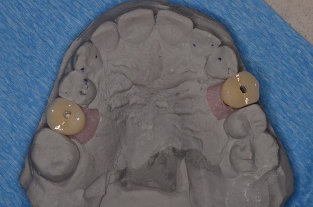 Dental Implants: Case 27 - After
