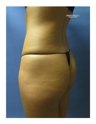 Brazilian Butt Lift Case 4 - Before