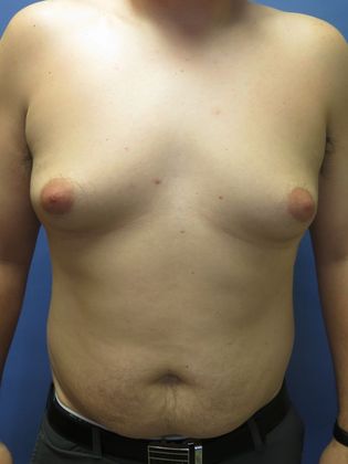 Gynecomastia Surgery (Male Breast Reduction Surgery) Case 1 - Before
