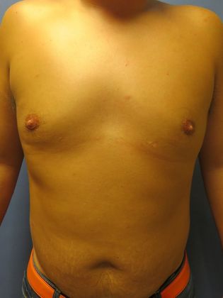 Gynecomastia Surgery (Male Breast Reduction Surgery) Case 1 - After