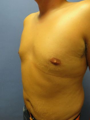 Gynecomastia Surgery (Male Breast Reduction Surgery): Case 1 - After