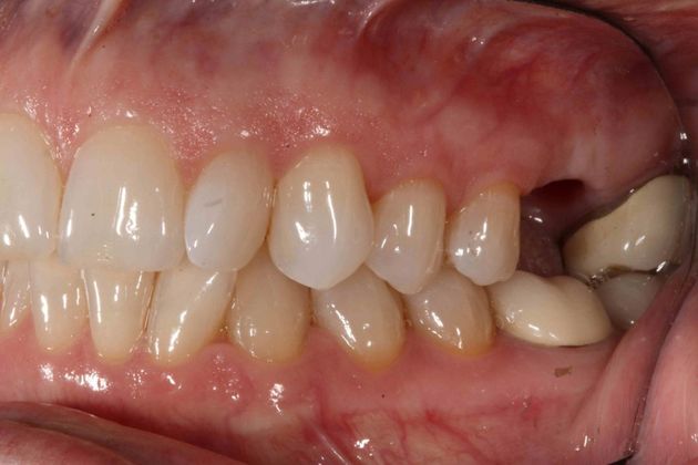 Dental Implants Case 5 - Before