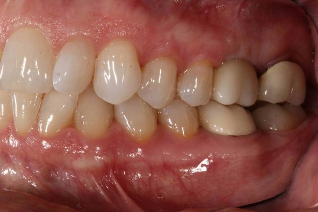 Dental Implants Case 5 - After