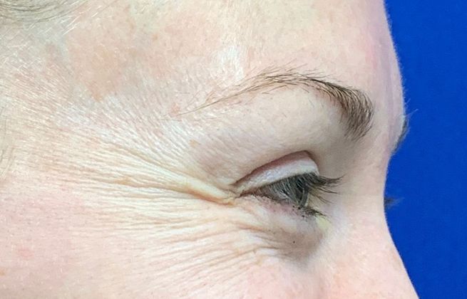 Injectables Botox, Dysport Neuromodulators: Case 1 (22318) - Before