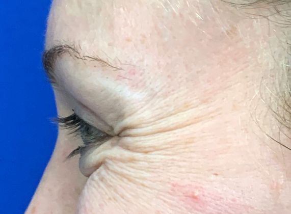 Injectables Botox, Dysport Neuromodulators Case 1 (22318) - Before