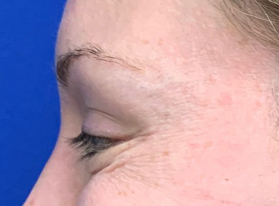Injectables Botox, Dysport Neuromodulators Case 1 (22318) - After