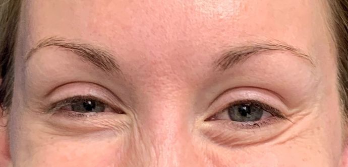 Injectables Botox, Dysport Neuromodulators: Case 1 (22318) - After, smiling