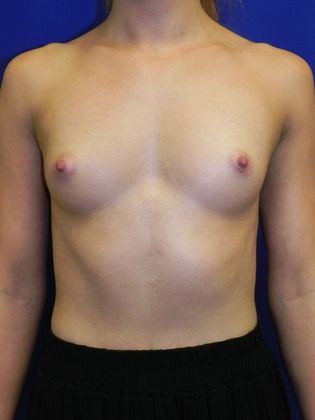 Breast Augmentation  Case 72 (21553) - Before