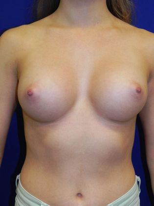 Breast Augmentation  Case 72 (21553) - After