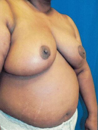Breast Reduction: Case 31 (20362) - After