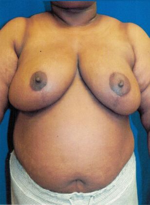 Breast Reduction: Case 31 (20362) - After