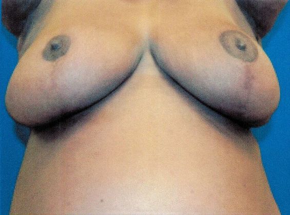 Breast Reduction: Case 31 (20362) - well healed scars