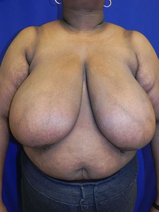 Breast Reduction: Case 31 (20362) - Before