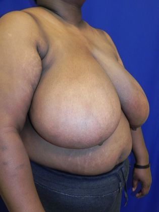 Breast Reduction: Case 31 (20362) - Before