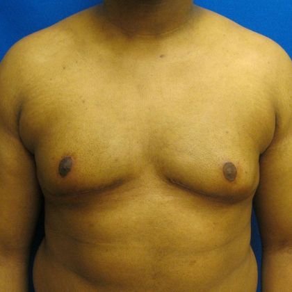 Gynecomastia Case 1 - After