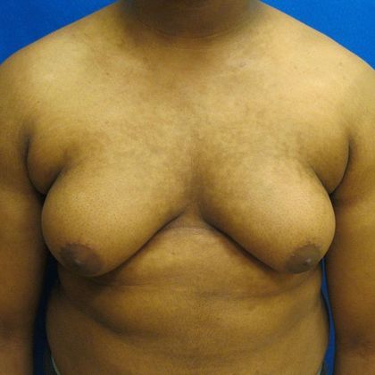 Gynecomastia Case 1 - Before