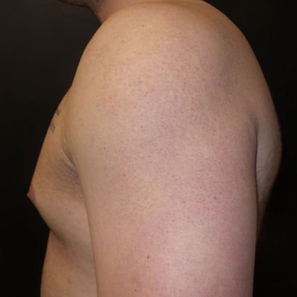 Gynecomastia Case 2 - Before
