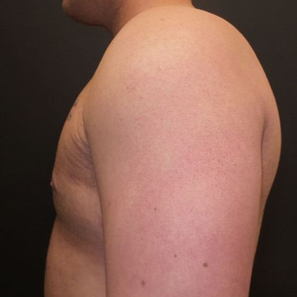 Gynecomastia Case 2 - After