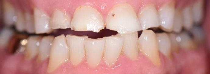 Tooth-colored Fillings Case 2 - Edna, TX - Before