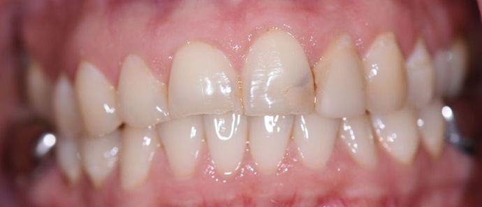 Tooth-colored Fillings Case 3 - Cuero, TX - Before