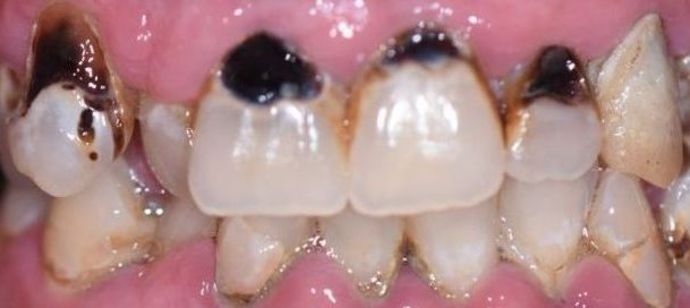 Tooth-colored Fillings Case 4 - Yoakum, TX - Before