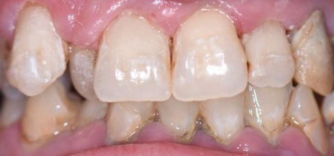 Tooth-colored Fillings Case 4 - Yoakum, TX - After
