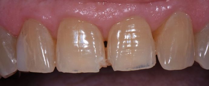 Tooth-colored Fillings: Case 5 - Halletsville, TX - Before